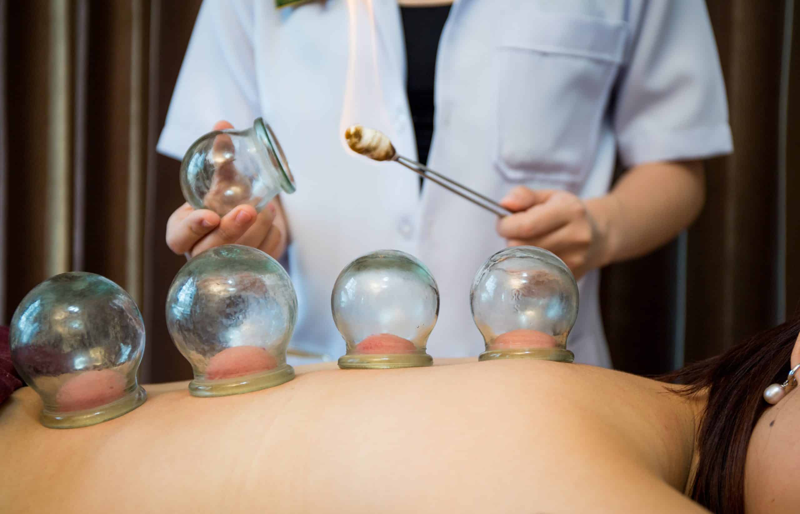 Practitioner lighting a glass cup during a fire cupping treatment on the back